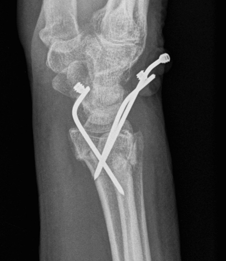 Distal Radius Fracture K wires Lateral